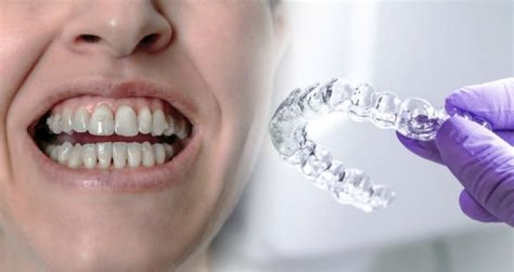 How Long Was B. Simone and Invisalign Together? A Comprehensive Look