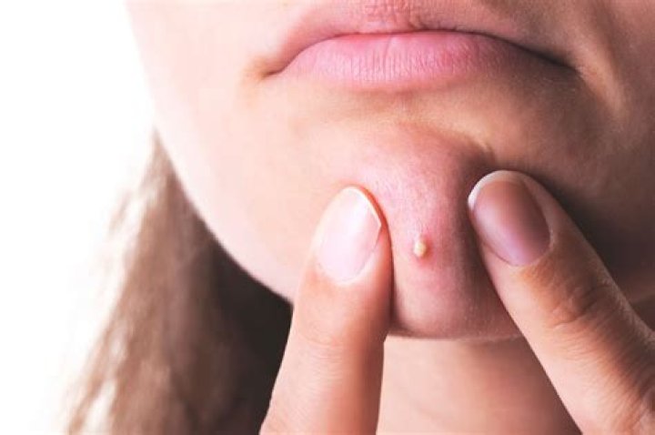 The Fascinating World of Zit Popping: Understanding the Science and Art Behind It