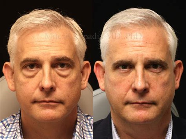 The Ultimate Guide to Kathy Fritz's Face Surgery: Before and After