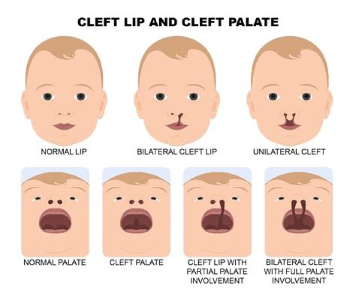 Unmasking Beauty: Celebrities with Cleft Lip